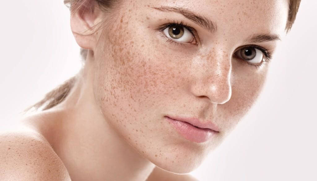 Nám da không gây đau đớn, ngứa rát hay mưng mủ nhưng lại ảnh hưởng đáng kể đến tính thẩm mỹ trên gương mặt